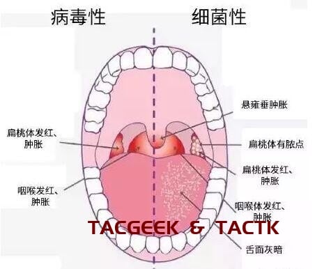 扁桃体(腺)